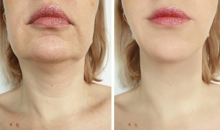 antes y despues del proceso de lifting facial en santiago de compostela