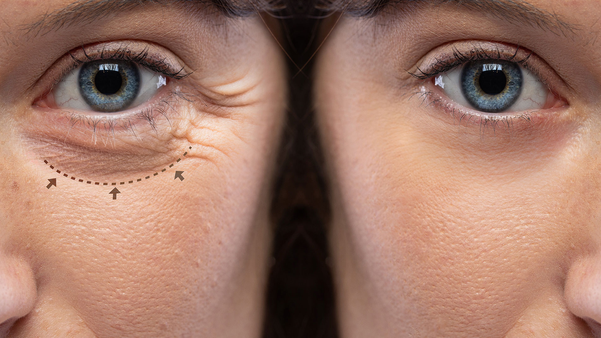 Comparación bótox y ácido hialurónico tratamientos faciales