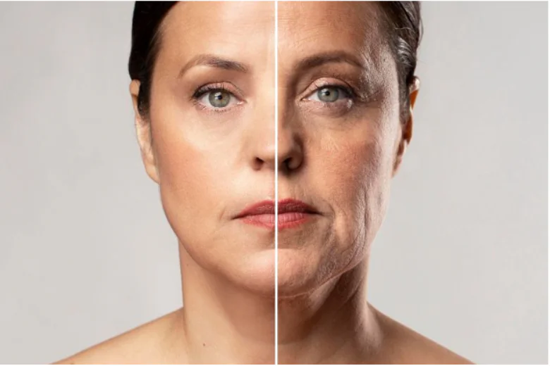 Tratamiento Profhilo para flacidez facial